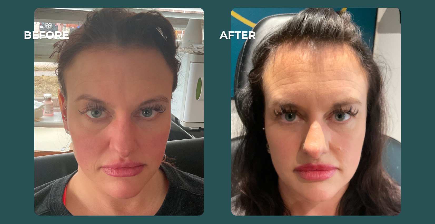 b&a_dermal-fillers-4